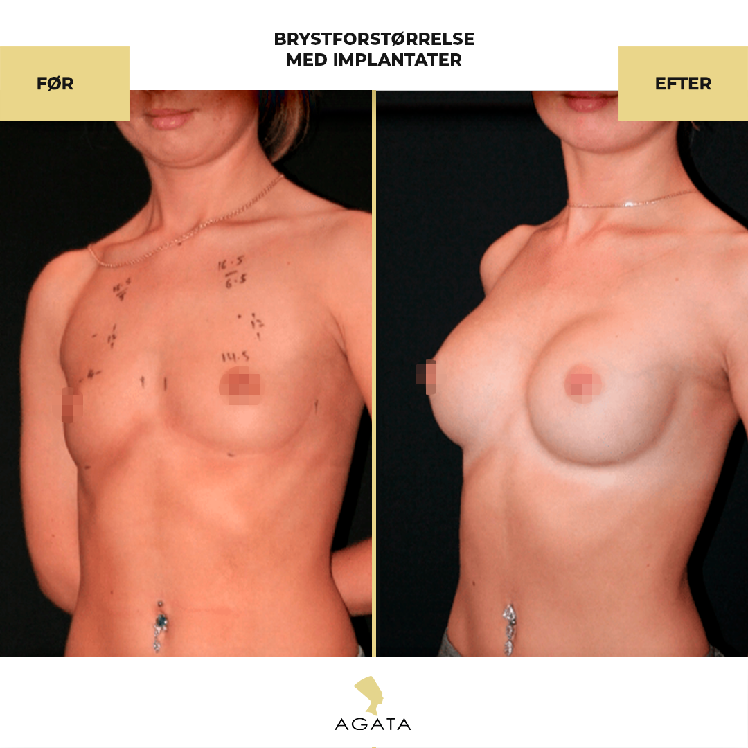 before_after_instagram_template_Brystbrystoperation-kopier-3