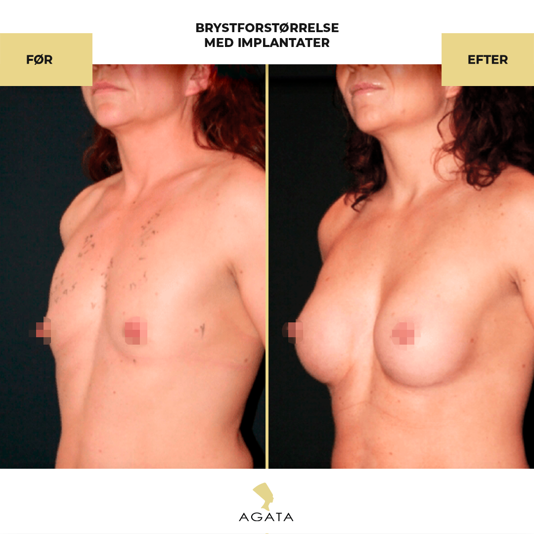 before_after_instagram_template_Brystbrystoperation-kopier-4-1