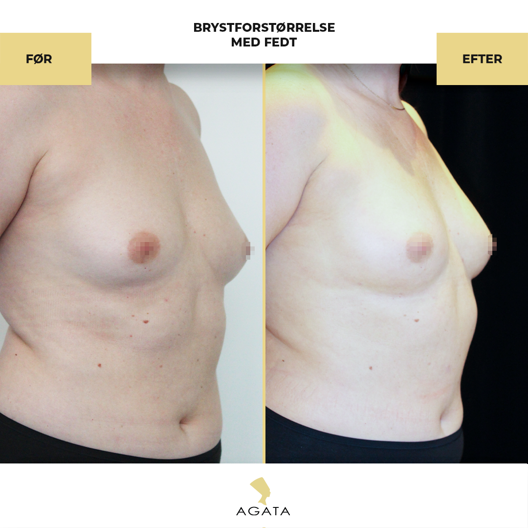 before_after_instagram_template_Brystbrystoperation-kopier-8