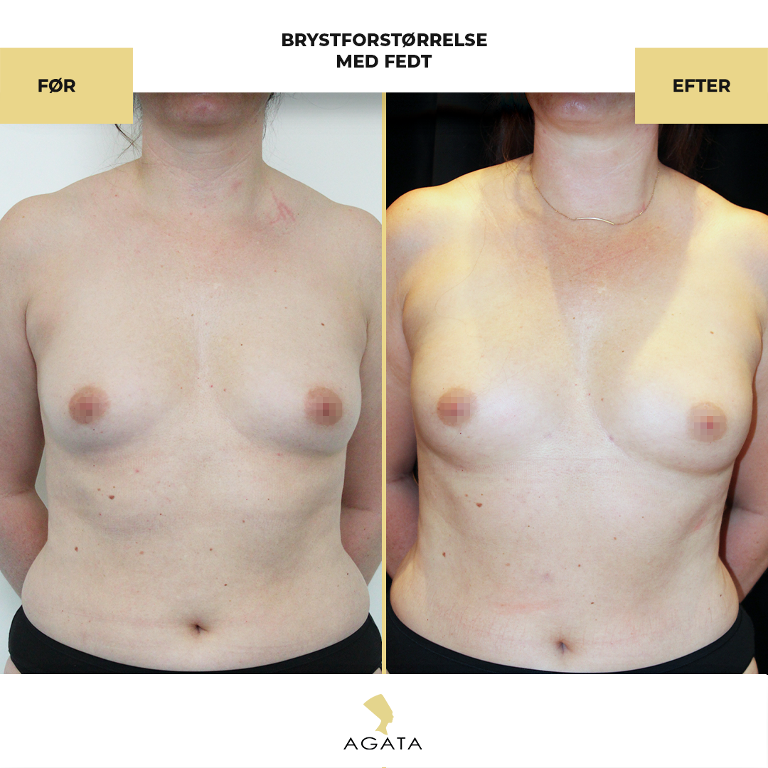 before_after_instagram_template_Brystbrystoperation-kopier-9